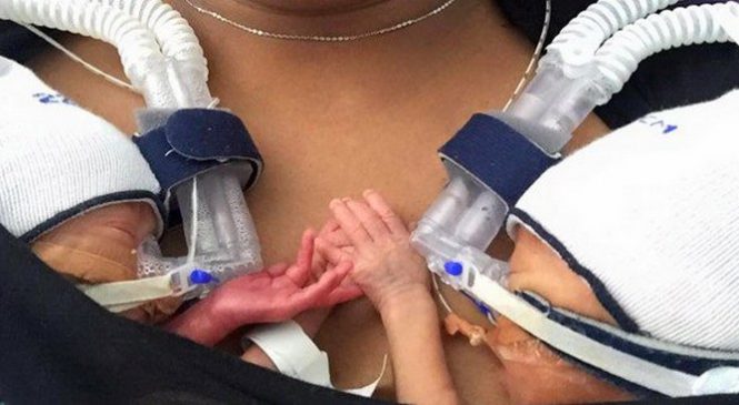 Deux jumeaux prématurés nés 11 semaines en avance refusent de se lâcher la main.
