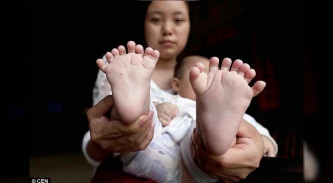 Ce bébé chinois est né avec 31 doigts et orteils !