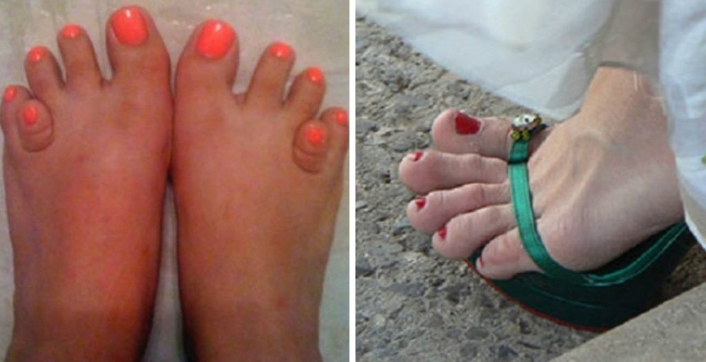 Le top des pieds les plus moches du monde. Vous allez cracher votre repas
