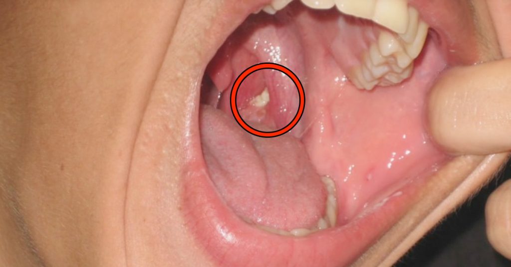 Sa mauvaise haleine ne part pas, il va chez le dentiste et il découvre ceci!