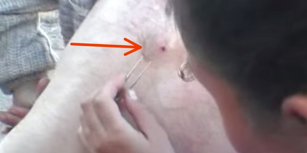 On croirait voir un gros bouton, mais quand elle sort la pince à épiler…