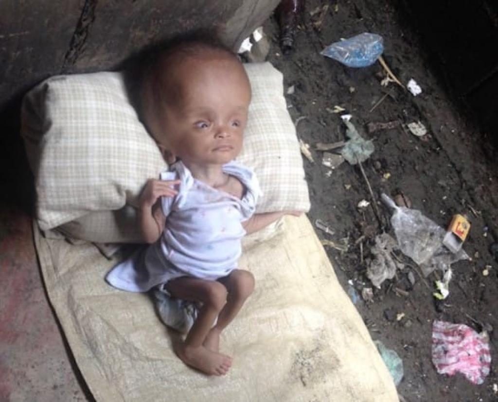 Elle trouve ce bébé dans un tas d&rsquo;ordures ! 2 ans plus tard, admirez ce qu&rsquo;il est devenu