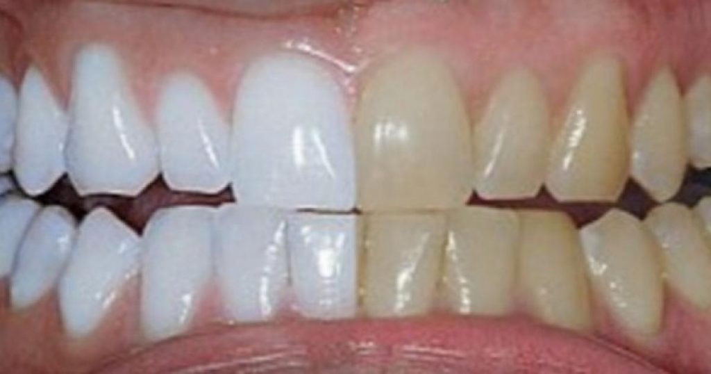 Il mélange des produits que nous avons tous à la maison. Quand il place le mélange sur ses dents ? Stupéfiant !