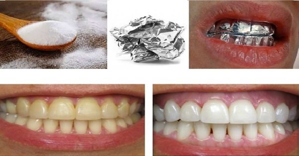 Enveloppez vos dents d’un papier aluminium pendant 1 heure et observez le résultat : c’est magique !