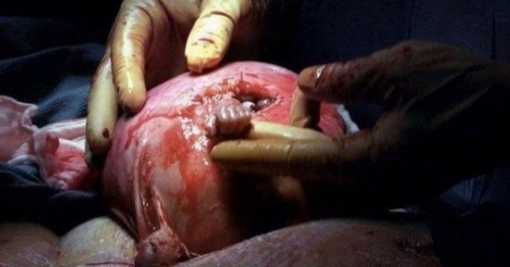 Ce foetus s’accroche au docteur qui pratique une opération de l’utérus. 16 ans plus tard, voilà ce qu’est devenu l’enfant.