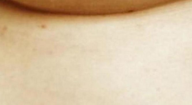 Cette photo montre un symptôme du cancer du sein que bien peu de gens connaissent. Le voyez-vous?