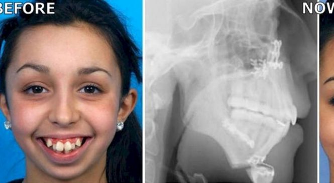 Elle a dû subir une importante chirurgie à la mâchoire. Admirez à quoi elle ressemble maintenant! C’est incroyable!