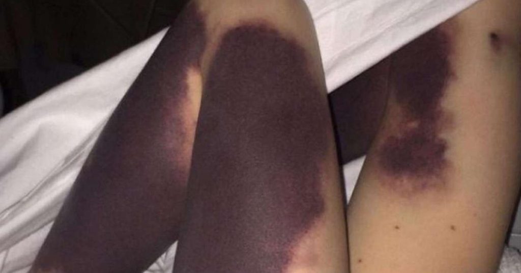 Sa fille se réveille, les jambes couvertes d’ecchymoses. La raison va vous choquer.