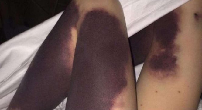 Sa fille se réveille, les jambes couvertes d’ecchymoses. La raison va vous choquer.