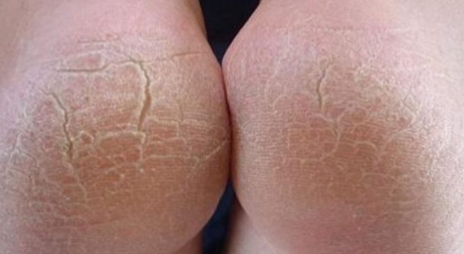 Voici comment régler votre problème de pieds trop secs et pas jolis !