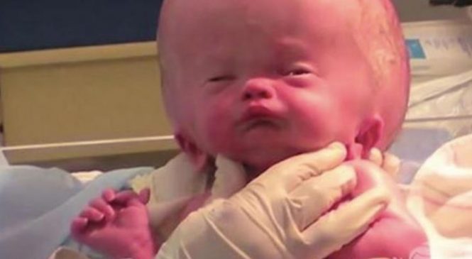 Ce petit bébé est né avec la tête très gonflé. 20 mois plus, voici ce qu’il est devenu!
