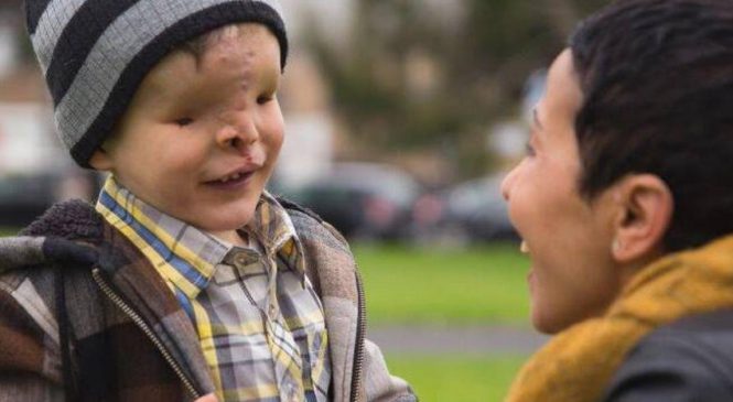 Ce garçon sans visage quitte son pays pendant 2 ans. Quand il revient, sa famille ne peut pas en croire ses yeux !