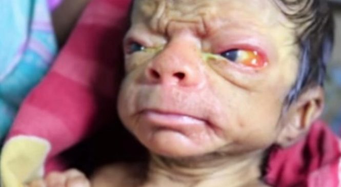 Quand les docteurs voient l’enfant, ils retiennent leur souffle: il ressemble à un homme de 80 ans!
