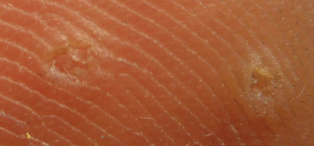 Comment soigner les verrues plantaires ? Les remèdes à connaître
